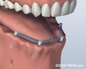 Implants Placed San Henderson, TX