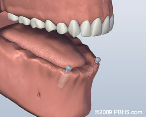 Implants Placed Henderson Smiles TX