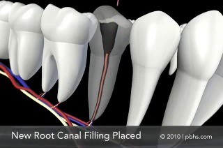 Root Canal Henderson Smiles TX